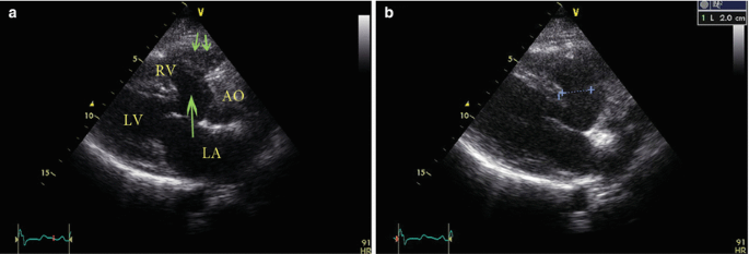 Nakata index above 1500 mm2/m2 predicts death in absent pulmonary valve  syndrome - Congenital Heart International Professionals (CHiP) Network