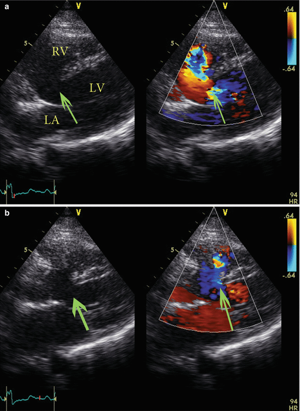 Nakata index above 1500 mm2/m2 predicts death in absent pulmonary valve  syndrome - Congenital Heart International Professionals (CHiP) Network