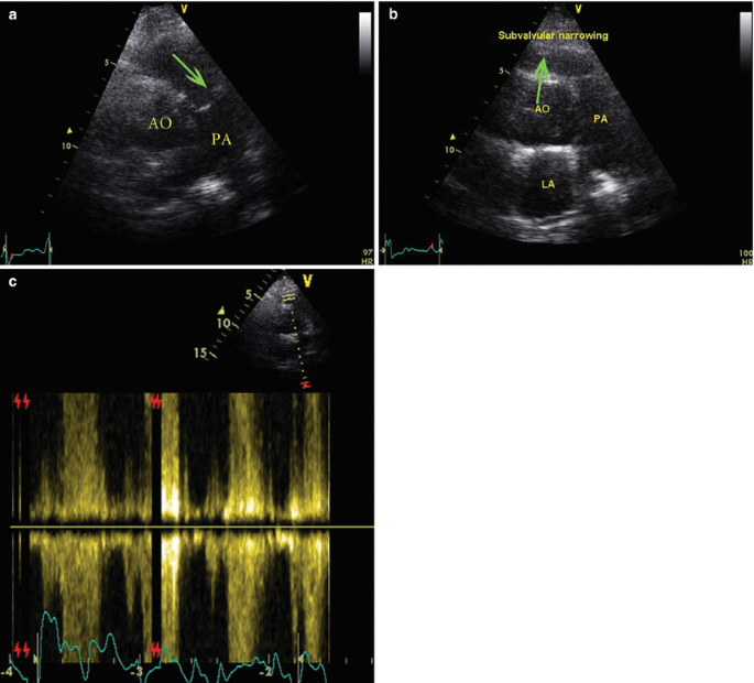 Nakata index above 1500 mm2/m2 predicts death in absent pulmonary valve  syndrome - Congenital Heart International Professionals (CHiP) Network