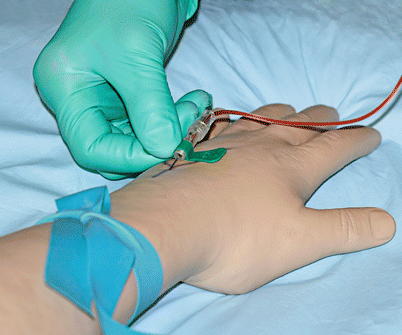 Performing a venipuncture using a butterfly needle 