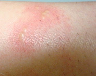 29 Year Old White Female with Grouped Blisters on Left Thigh
