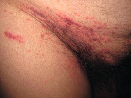 Blistering rash in the groin - Clinical Advisor