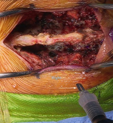 Dorsal Root Entry Zone (DREZ ) Lesion | SpringerLink