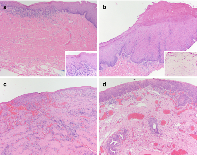 Histopathology of Oral Cavity Cancer and Potentially Malignant Disorders |  SpringerLink