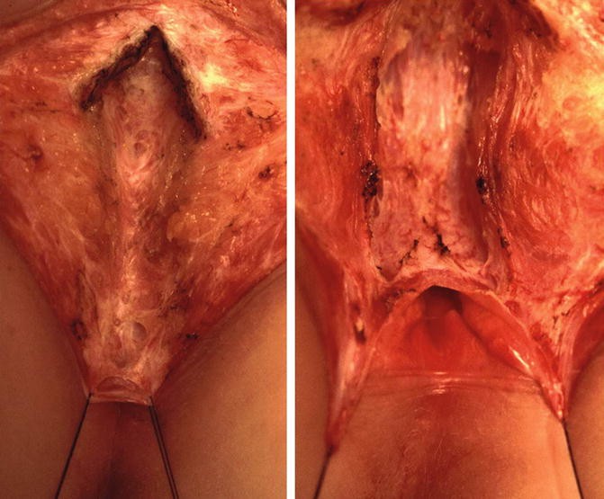 Case 52-1991 — An Eight-Year-Old Girl with Recurrent Abdominal Distention  after Surgical Correction of Hirschsprung's Disease