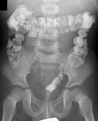 Case 52-1991 — An Eight-Year-Old Girl with Recurrent Abdominal Distention  after Surgical Correction of Hirschsprung's Disease