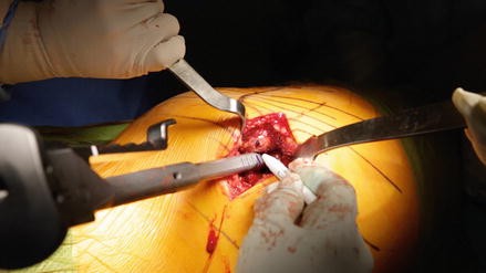 Total Hip Replacement Surgery Video