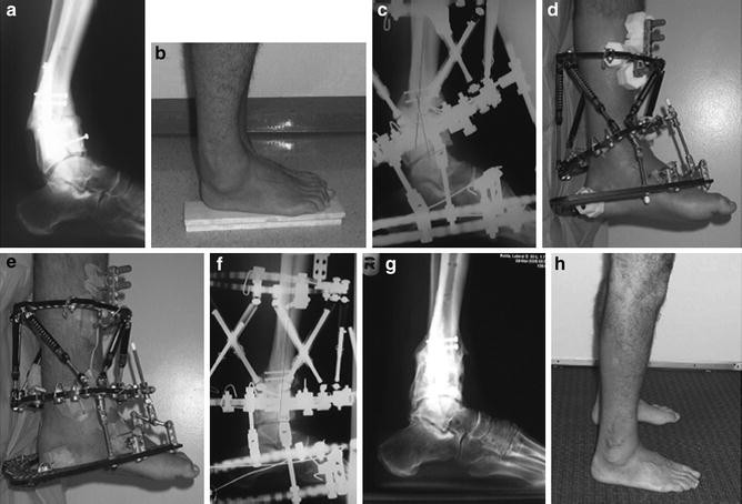 Minimally invasive distal tibial osteotomy and correction of deformity with  the Taylor Spatial Frame – Orthoracle LuanMD