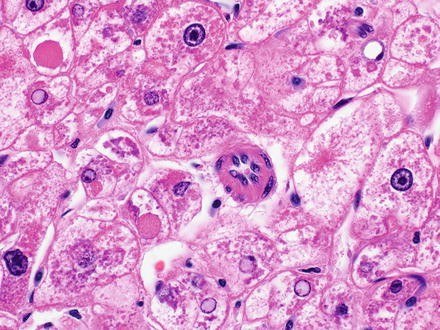 Hepatocellular Carcinoma | SpringerLink