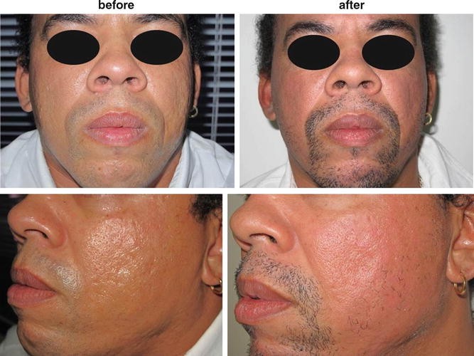 Fractional Ablative and Non-Ablative Lasers for Ethnic Skin | SpringerLink