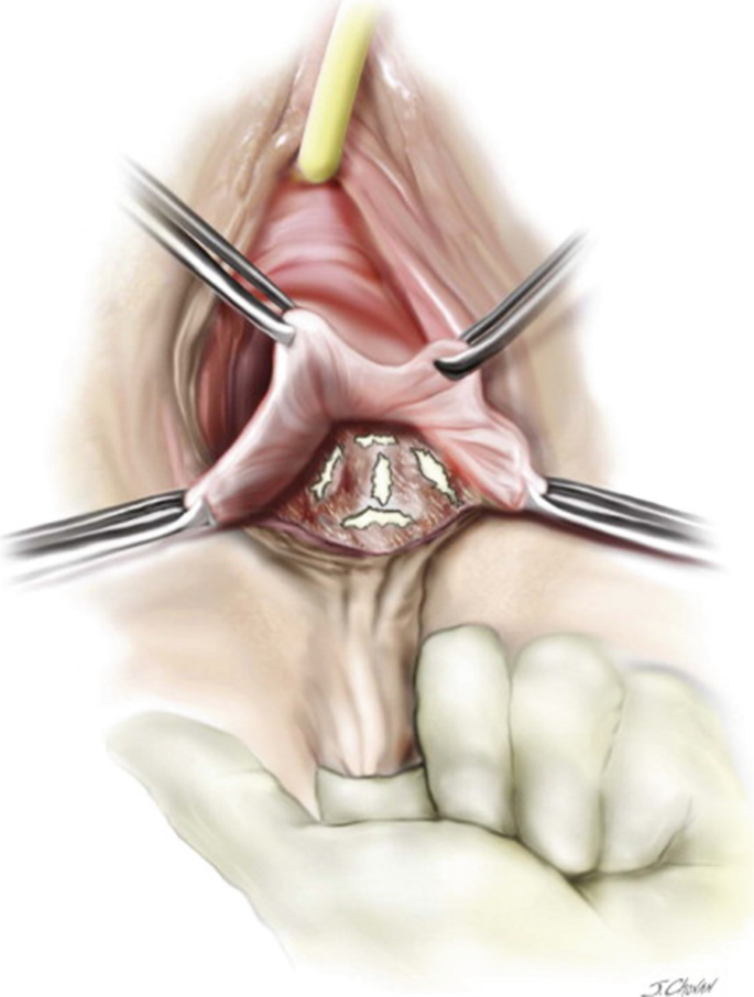 Pin by Sat Deol on Hip muscles  Pelvic organ prolapse, Pelvic