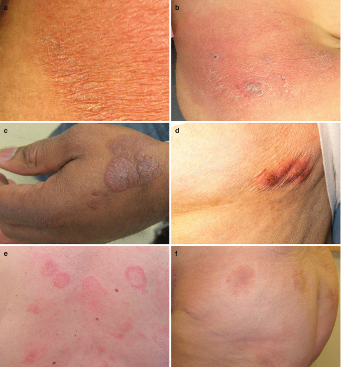 Mycosis Fungoides