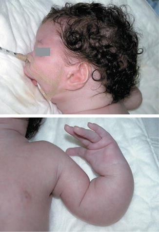 4 Newborn with Rubinstein-Taybi syndrome showing microcephaly