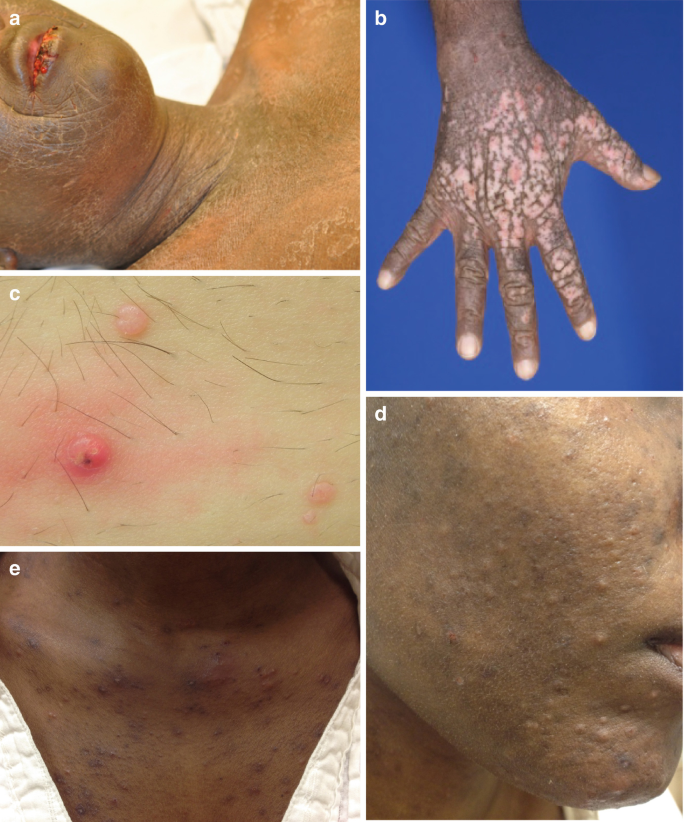 Dermatitis rash viral disease with immunodeficiency on body of