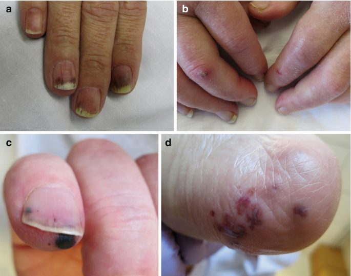Infective Endocarditis | Dr Qaisar Ahmed MD, DHMS