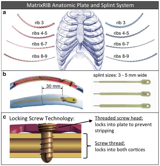 Biomechanics of Rib Fracture Fixation | SpringerLink