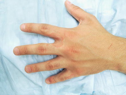 Interdigital Candidiasis | SpringerLink
