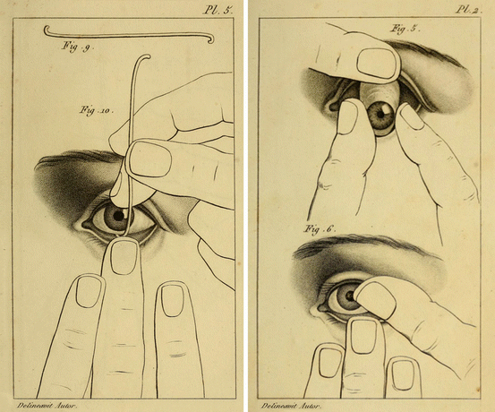 The History and Evolution of Prosthetic Eyes, Blog