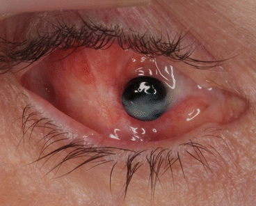 Mucoid Discharge Associated with Prosthetic Eye Wear | SpringerLink