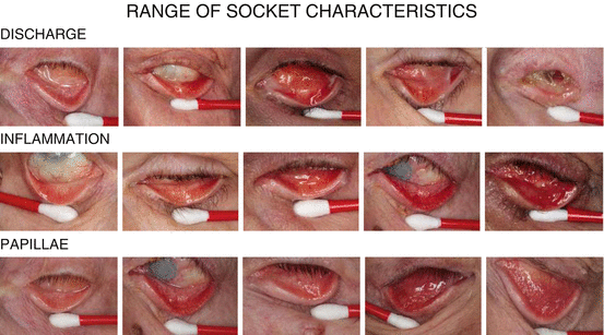 Mucoid Discharge Associated with Prosthetic Eye Wear | SpringerLink