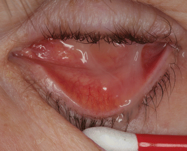 Mucoid Discharge Associated with Prosthetic Eye Wear | SpringerLink
