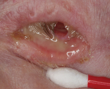 Mucoid Discharge Associated with Prosthetic Eye Wear | SpringerLink