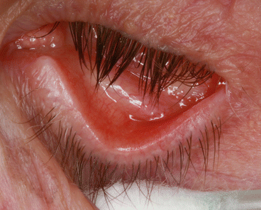 Mucoid Discharge Associated with Prosthetic Eye Wear | SpringerLink