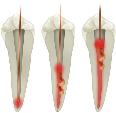 Conventional Laser Endodontics | SpringerLink