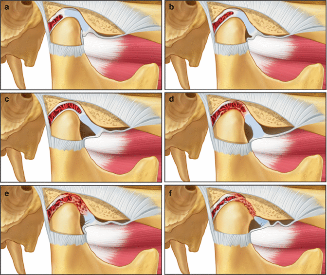 Temporomandibular Disorders: Etiology and Classification