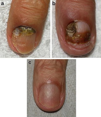 Pseudomonas bacterial nail infection - Stock Image - C037/4757 - Science  Photo Library