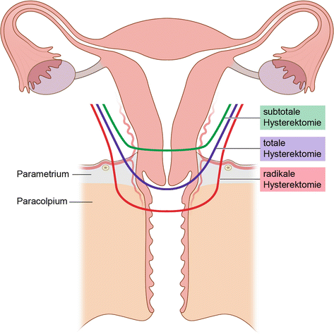 Total Laparoscopic Hysterectomy for the Small and Normal-Sized Uterus |  SpringerLink