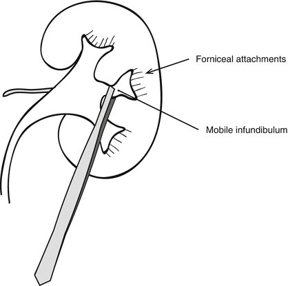 Applied Anatomy for Percutaneous Access | SpringerLink