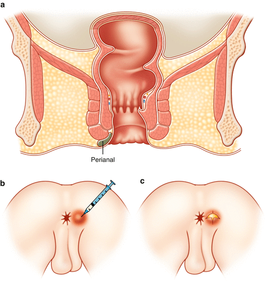 Anorectal Abscess | SpringerLink