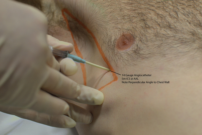 Needle Thoracostomy for decompression of Tension Pneumothorax | SpringerLink