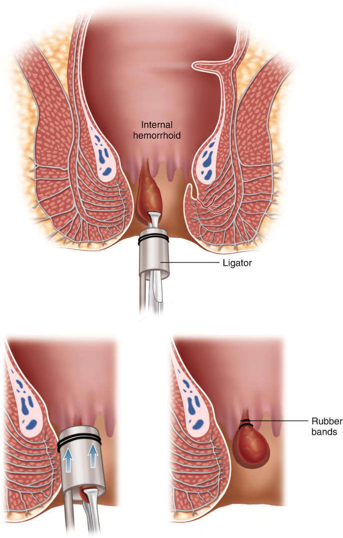 Top Piles Doctors in Mysore - Best Surgeons For Hemorrhoids near me -  Justdial