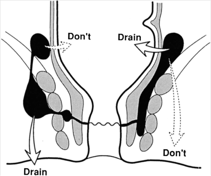 Anorectal Abscess and Fistula SpringerLink picture