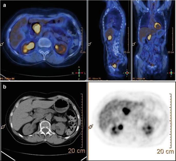 Teaching Cases in Nuclear Oncology: Pancreatic Cancer | SpringerLink