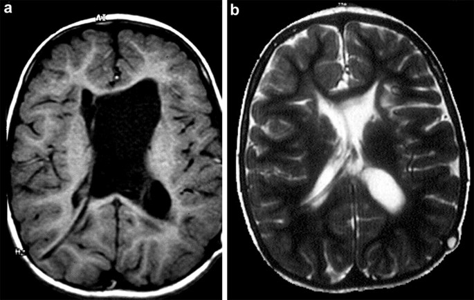 Long-term recovery behavior of brain tissue in hydrocephalus patients after  shunting