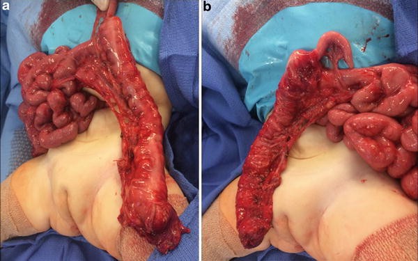 Case 52-1991 — An Eight-Year-Old Girl with Recurrent Abdominal Distention  after Surgical Correction of Hirschsprung's Disease