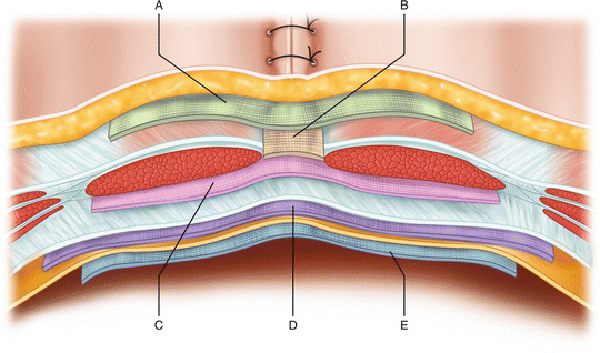Abdominal Wall Spaces for Mesh Placement: Onlay, Sublay, Underlay |  SpringerLink
