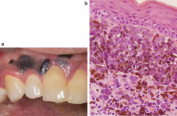 Pigmented Lesions of the Oral Mucosa
