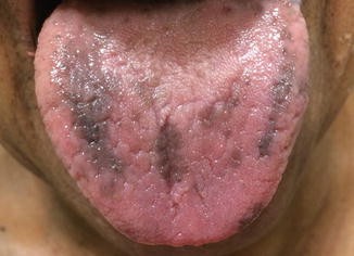 melanotic tongue Pigmented Lesions of the Oral Mucosa