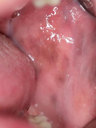 Pigmented Lesions of the Oral Mucosa
