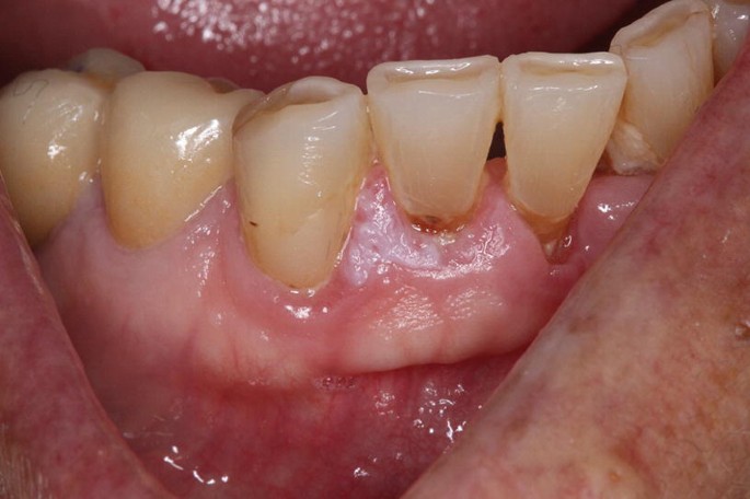 Oral Mucosal Malignancies | SpringerLink