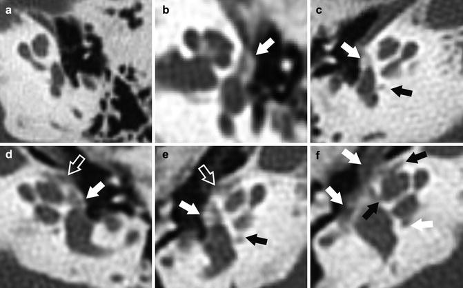 The Stapes in Otosclerosis: Osteoarthritis of an Ear Ossicle