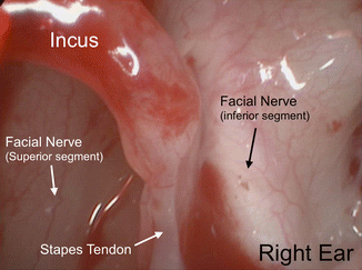 Congenital stapes suprastructure fixation presenting with