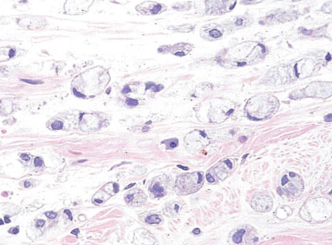 File:Gross pathology and histopathology of signet ring cell carcinoma  metastasis to the ovary.jpg - Wikipedia