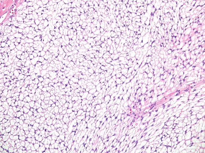 Schwannoma (All Variants) | Springer Nature Link