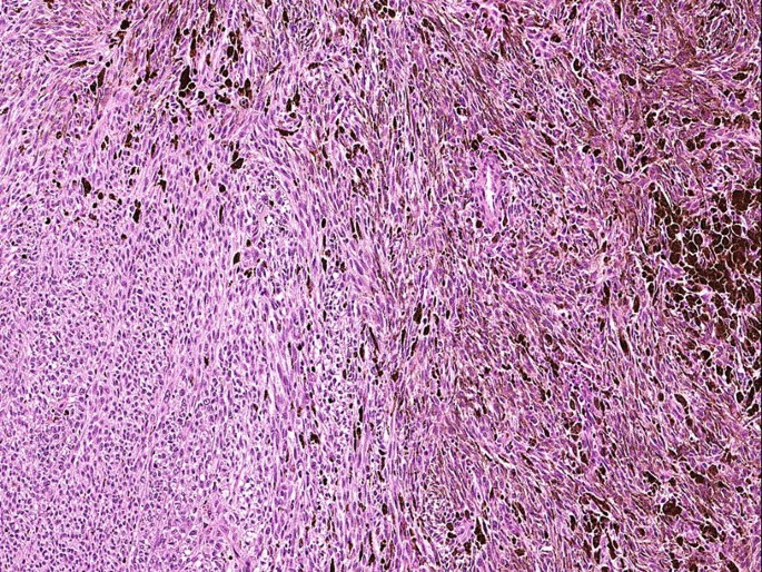 melanotic schwannoma pathology Schwannoma (Neurilemmoma)...Explained by a Soft Tissue Pathologist main image 0