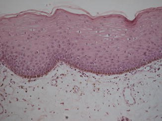 melanotic macule histology Melanotic Macule main image 1